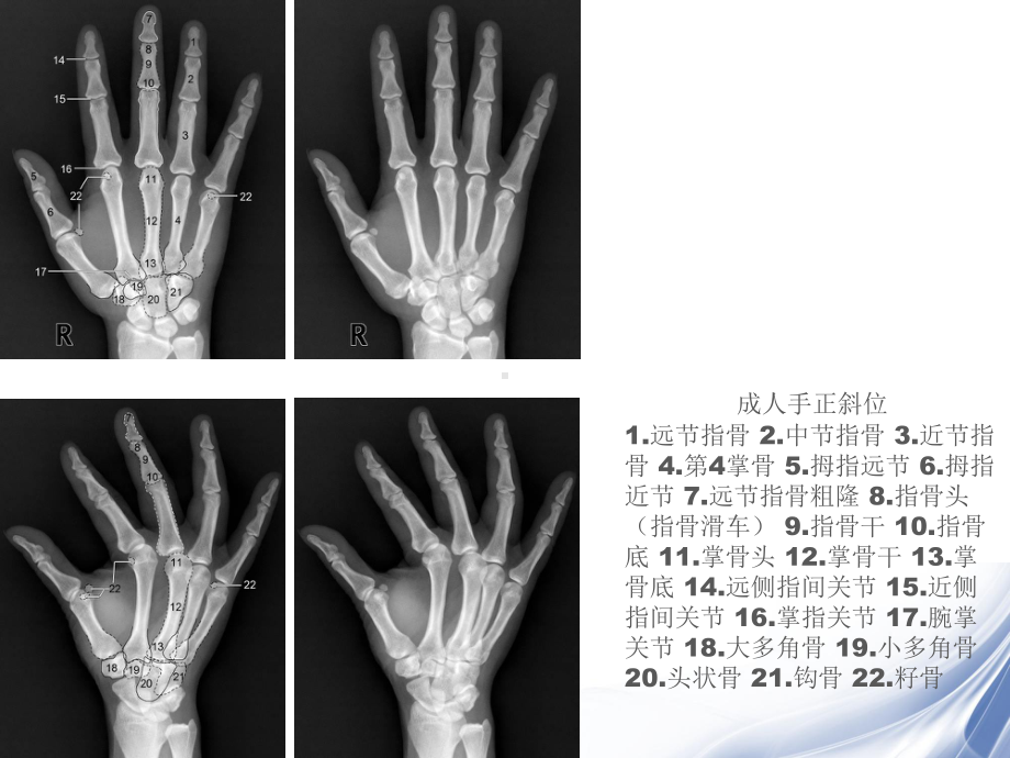 四肢关节正常变异、常见病变与创伤课件.ppt_第3页