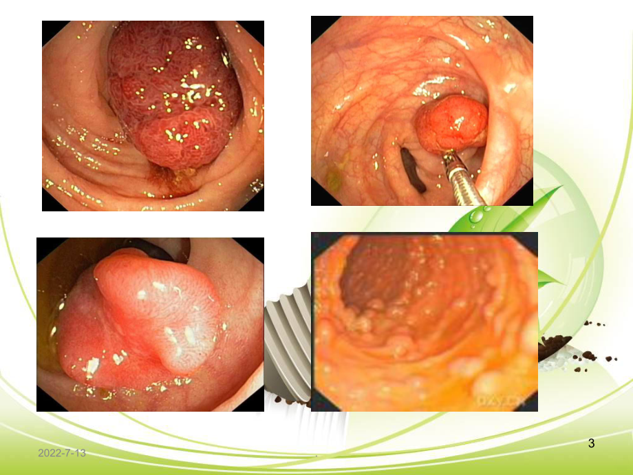 胃息肉的护理PPT课件.ppt_第3页