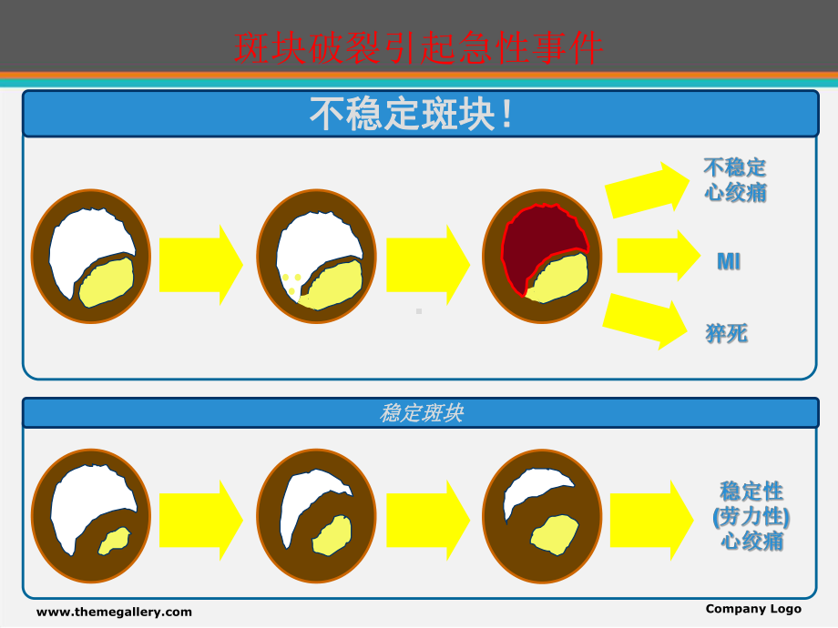 急性心梗诊断治疗新视点-ppt课件.ppt_第3页