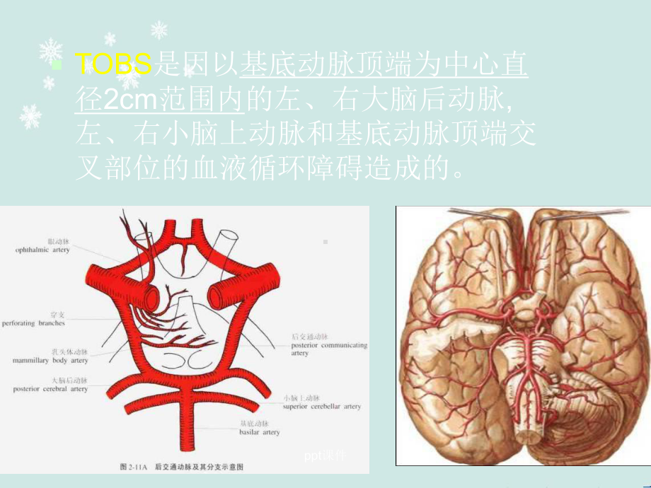 基底动脉尖综合征.-ppt课件.ppt_第3页