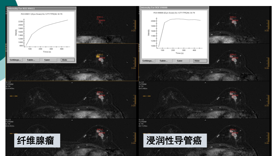 乳腺病变的MRI图像解读及BI-RADS-分类课件.ppt_第3页