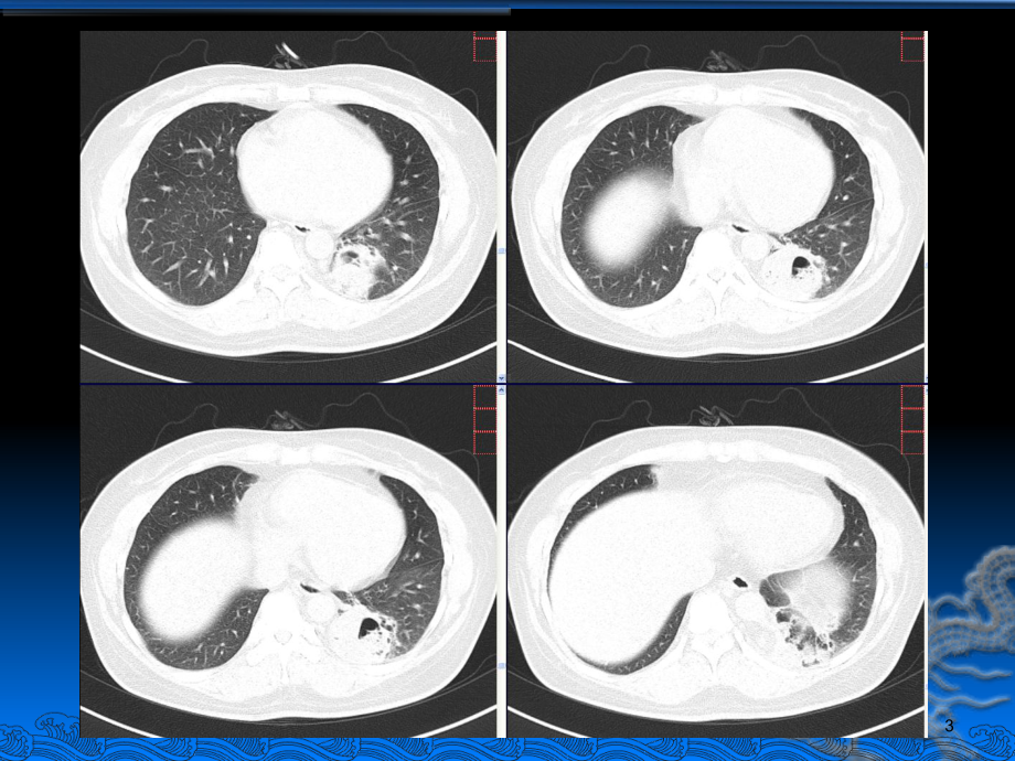 肺隔离症影像诊断ppt课件.ppt_第3页