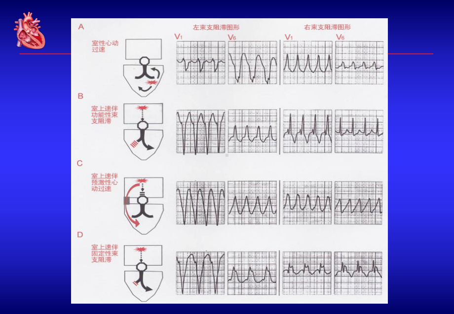 宽QRS波心动过速的鉴别诊断课件.ppt_第3页