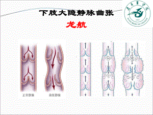 下肢大隐静脉曲张ppt课件.ppt