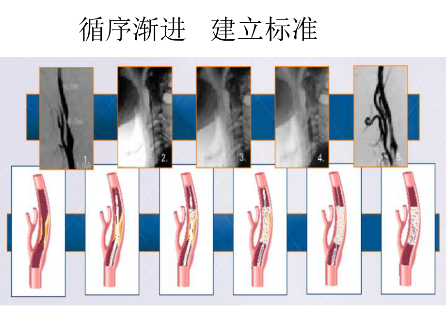 颈动脉支架手术步学习资料课件.ppt_第2页