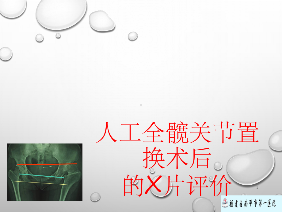 一文看懂全髋关节置换术后的X线评价-ppt课件.ppt_第1页