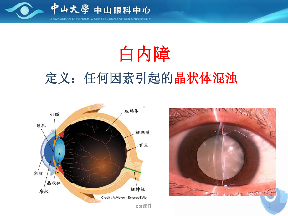 白内障及其治疗-ppt课件.ppt_第3页