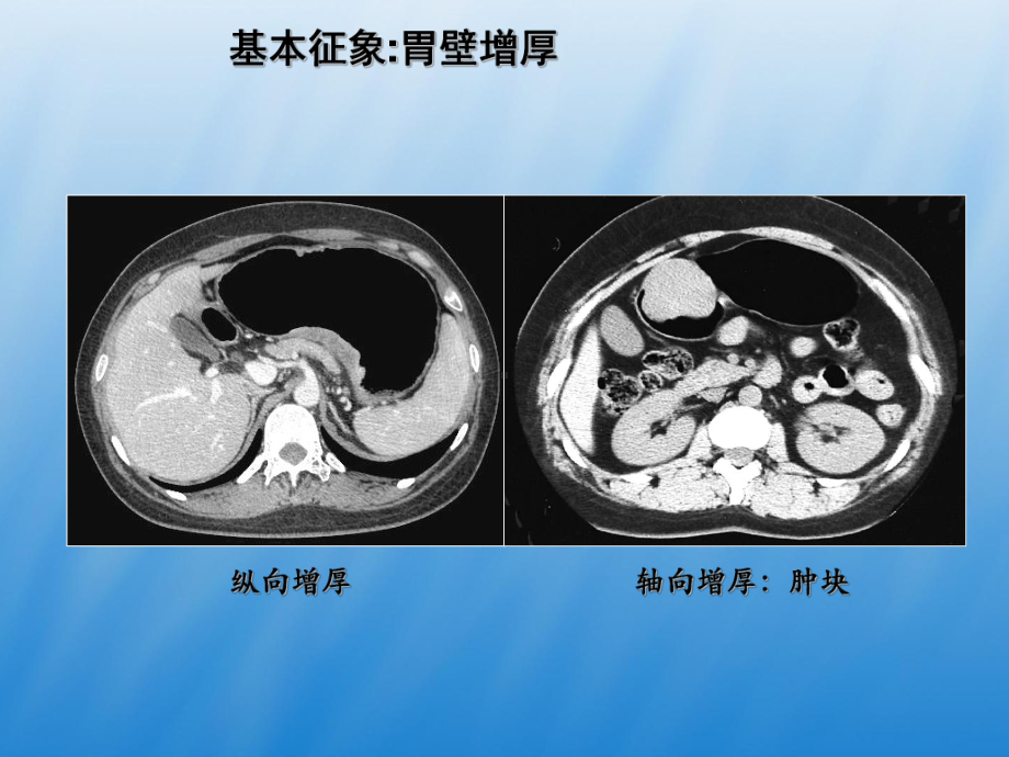 胃癌影像诊断PPT课件1.ppt_第2页