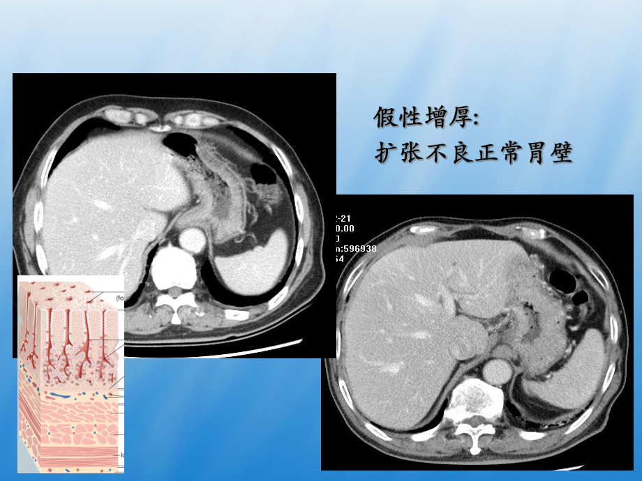 胃癌影像诊断PPT课件1.ppt_第3页