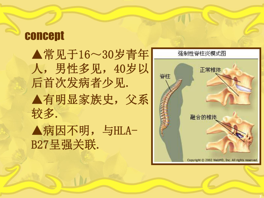 强直性脊柱炎-PPT课件(同名216).ppt_第3页