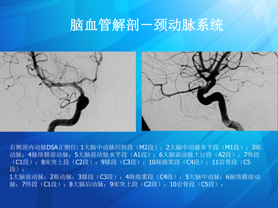 动脉瘤讲课课件.ppt_第2页