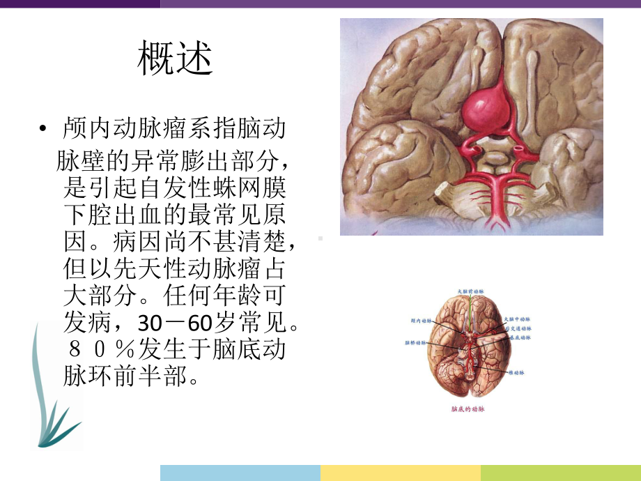 颅内动脉瘤-ppt课件.ppt_第2页