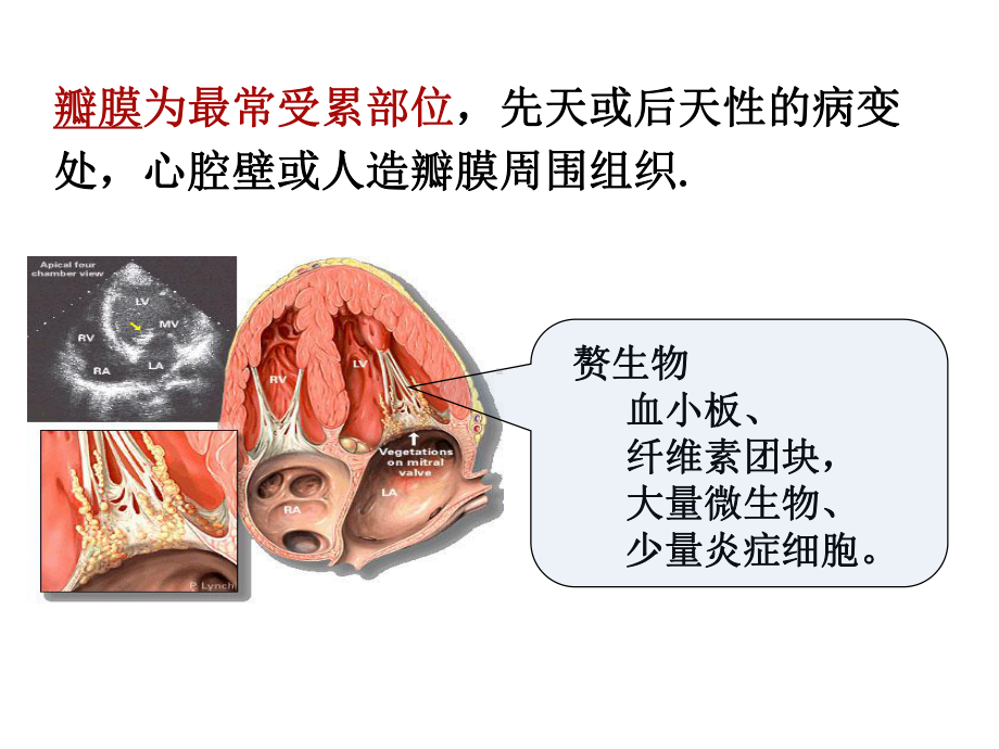 感染性心内膜炎病人的护理课件.pptx_第3页