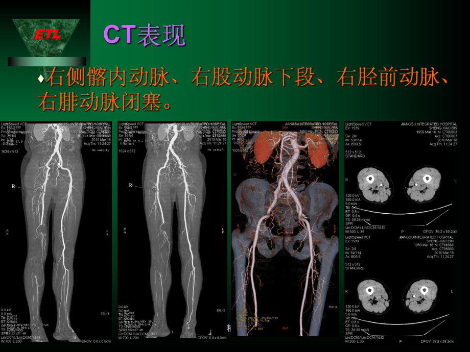 下肢动脉血栓诊疗ppt课件.ppt_第3页