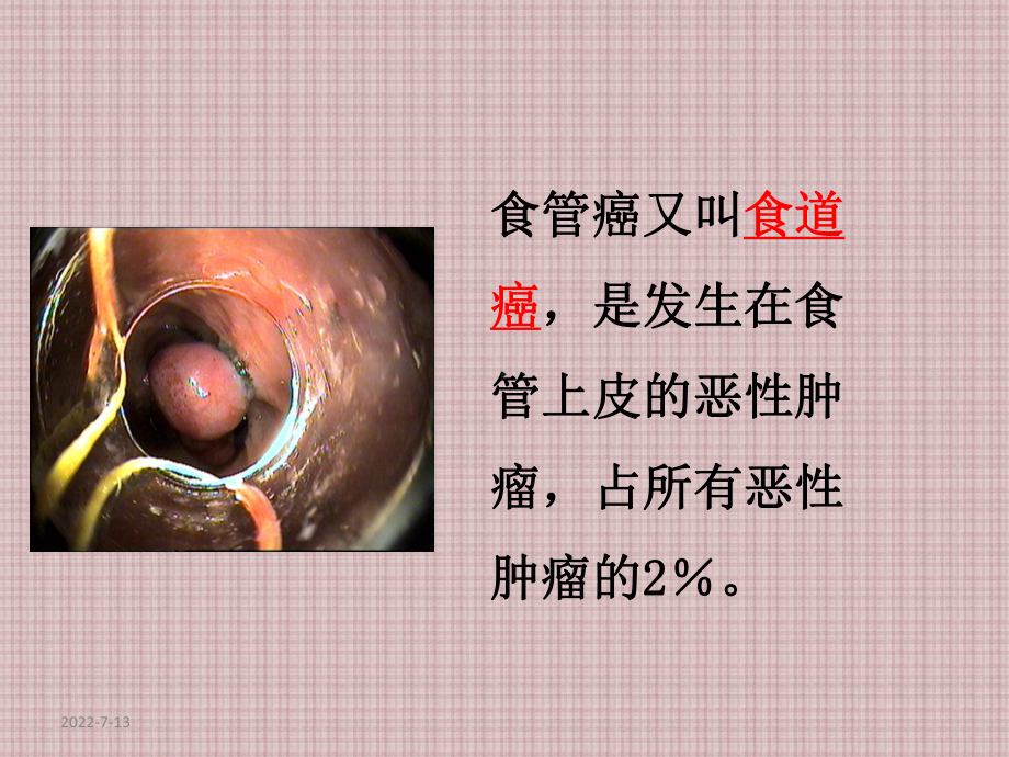 食管癌护理PPT课件.ppt_第2页