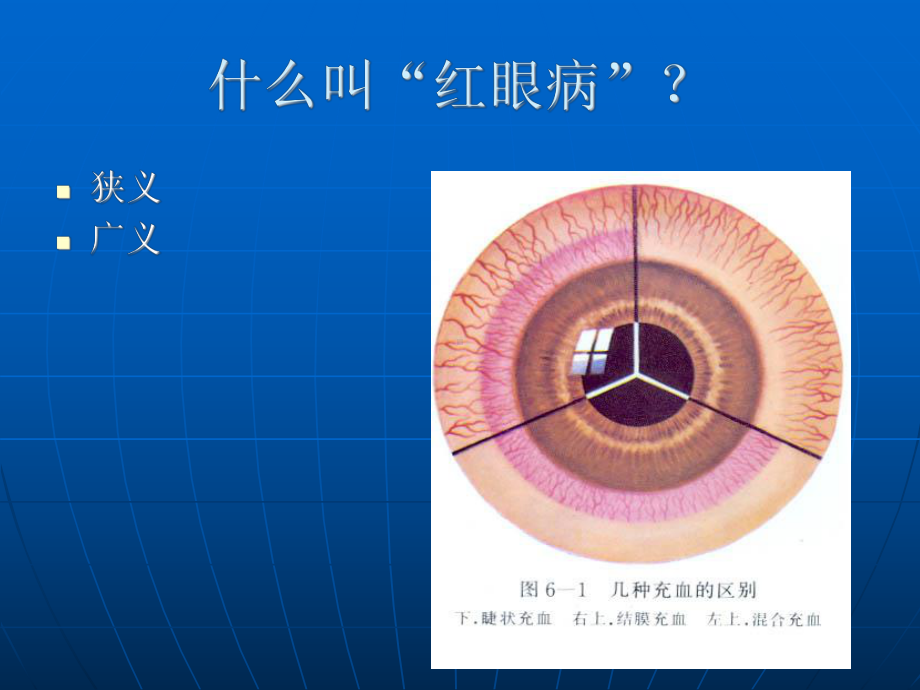 红眼病的鉴别诊断课件.ppt_第2页