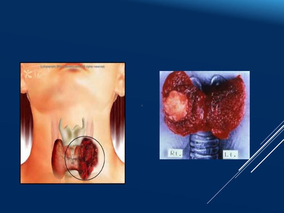 甲状腺TI-RADS分类PPT课件.ppt_第2页