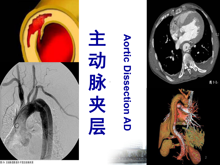 主动脉与周围血管病PPT课件.ppt_第2页