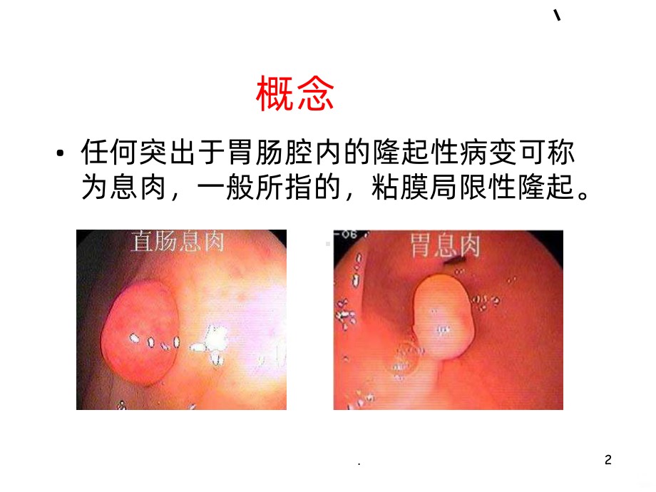 胃肠息肉PPT课件.ppt_第2页