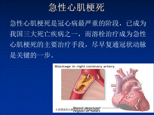 小讲课急性心梗溶栓术后并发症的观察培训课件.ppt