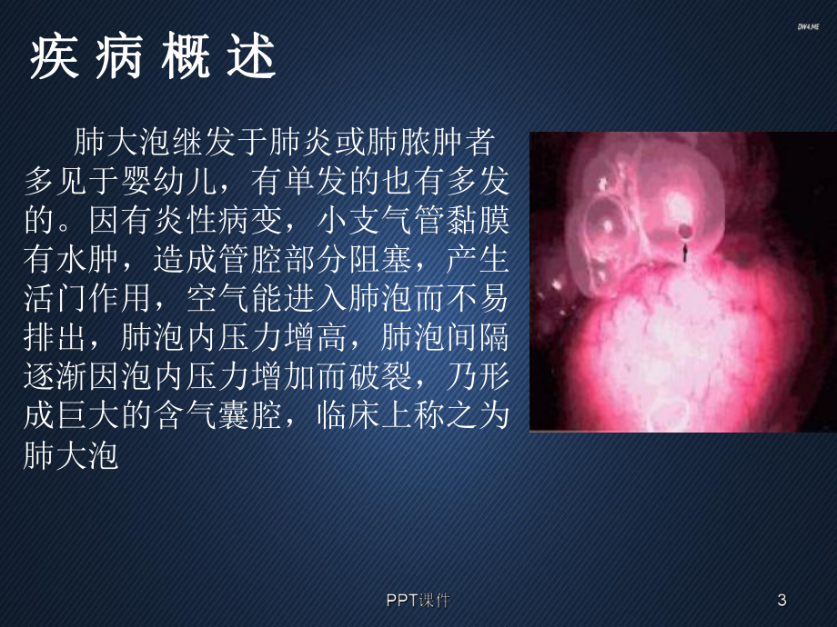 胸腔镜肺大疱切除-ppt课件.ppt_第3页