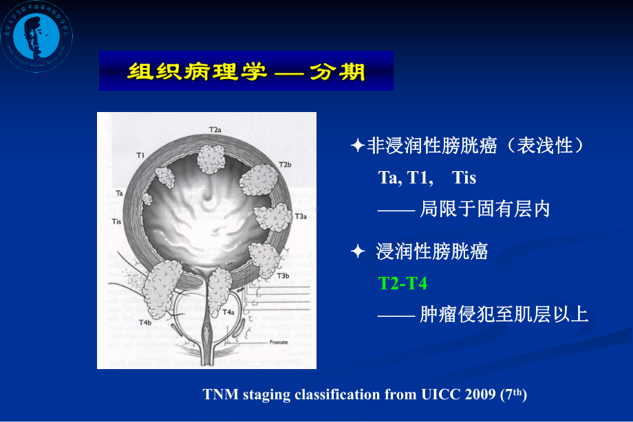 浸润性膀胱癌保留膀胱的治疗课件.ppt_第2页