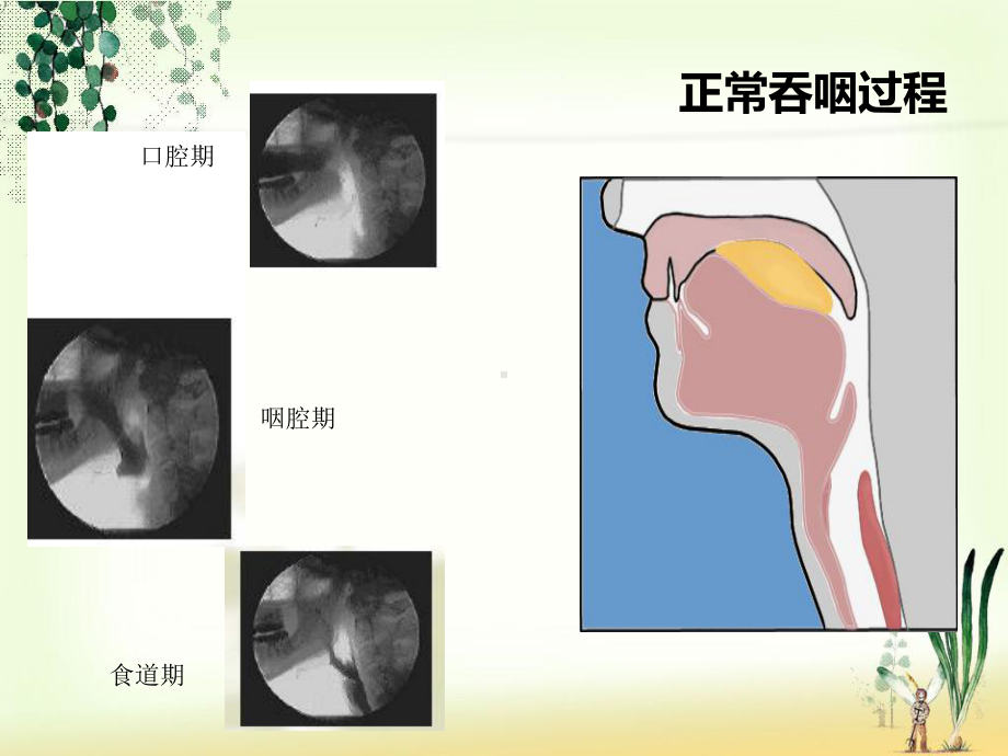 吞咽障碍临床治疗课件.ppt_第3页