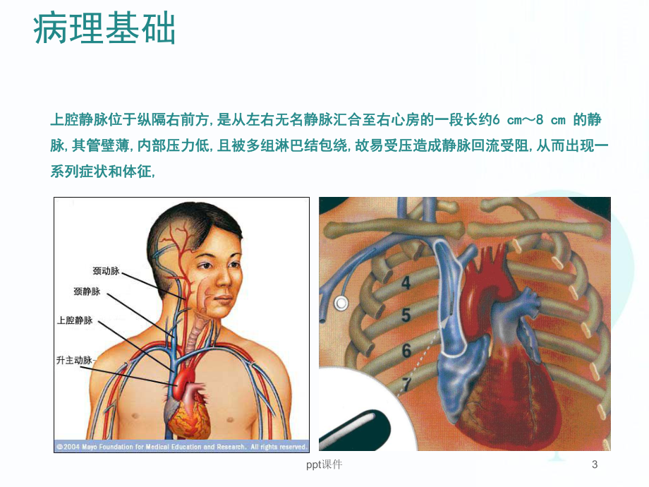 上腔静脉综合征-ppt课件.ppt_第3页