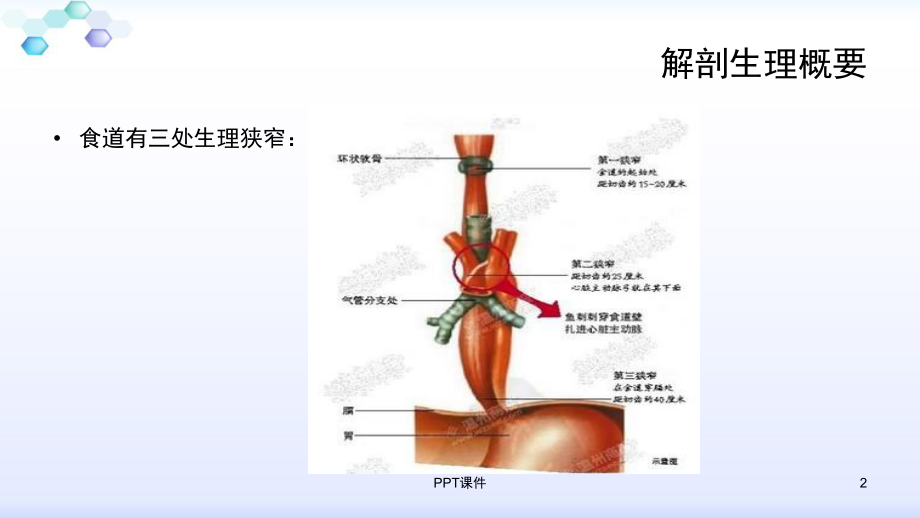 食管癌术后护理-ppt课件.ppt_第2页