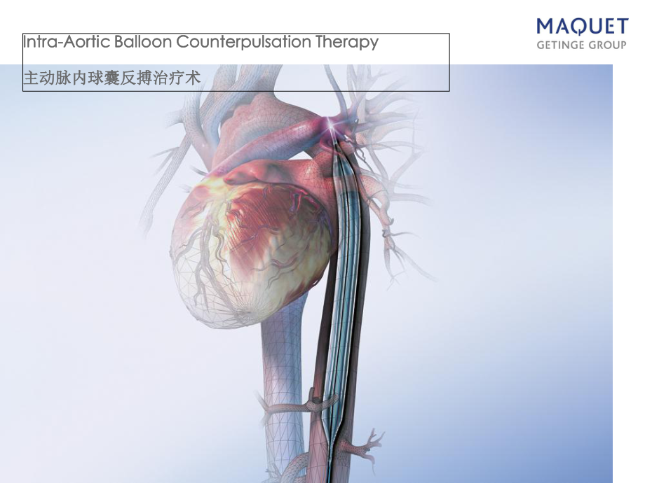 主动脉内球囊反搏术ppt课件1.ppt_第1页
