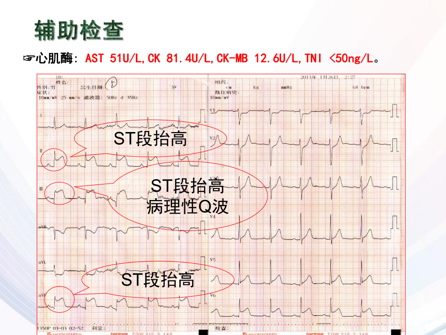 PBL急性心梗护理课件.ppt_第3页