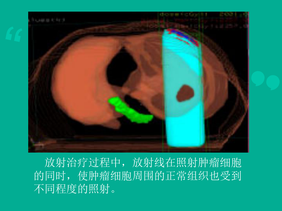 放射治疗技术-ppt课件.ppt_第3页