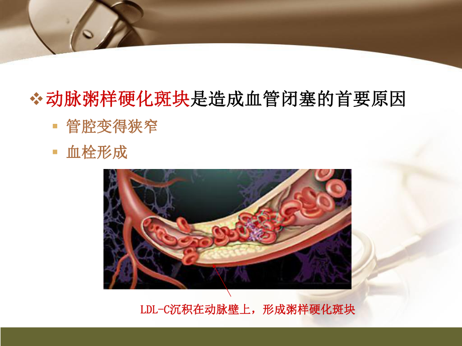 心肌梗死健康宣教CCU课件.pptx_第3页