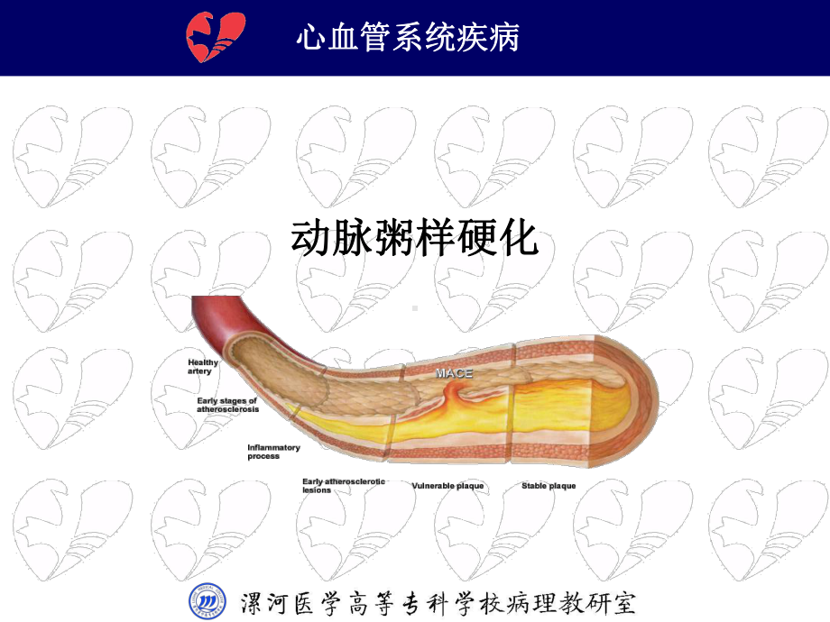 动脉粥样硬化PPT课件.ppt_第3页