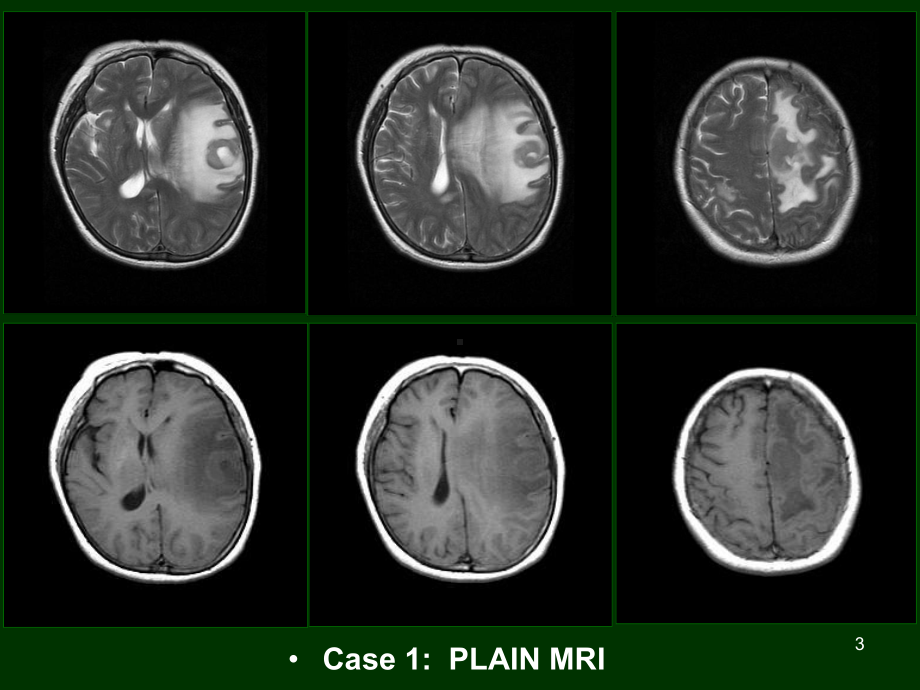 颅内淋巴瘤影像诊断PPT课件.ppt_第3页