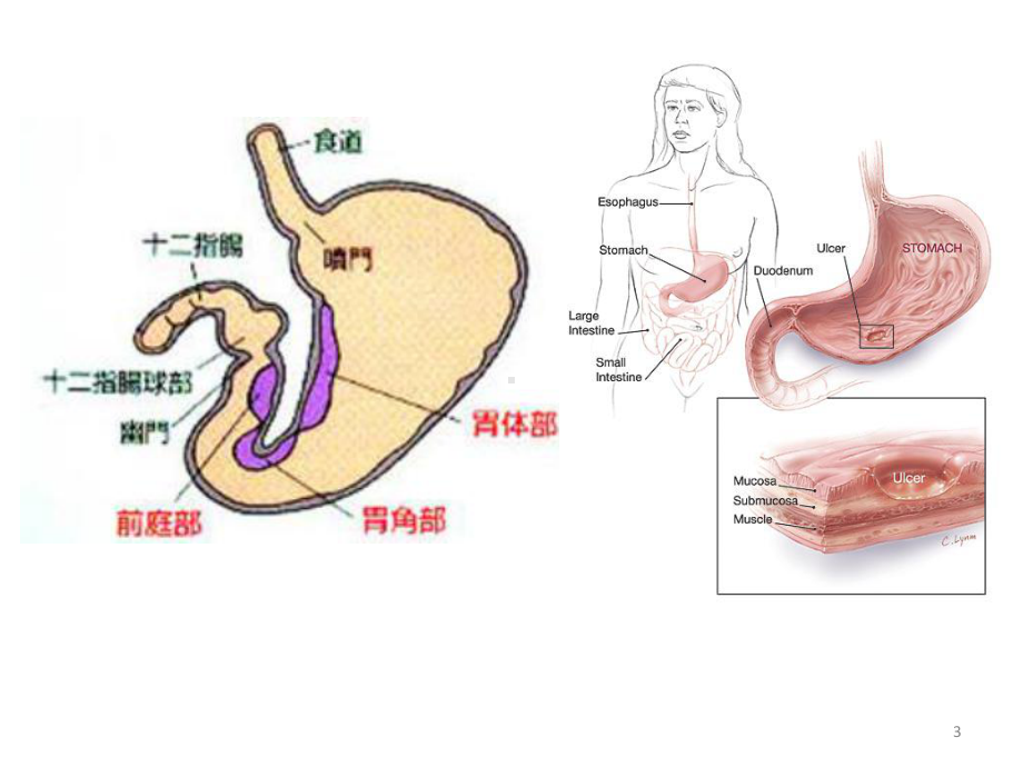 消化性溃疡的诊断及治疗课件.pptx_第3页