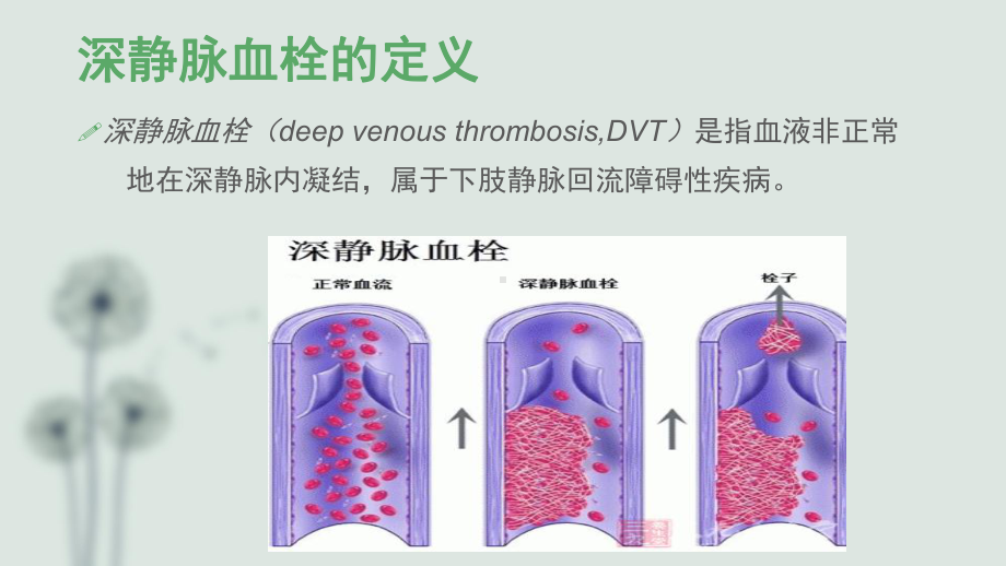 深静脉血栓评估PPT培训课件.ppt_第2页