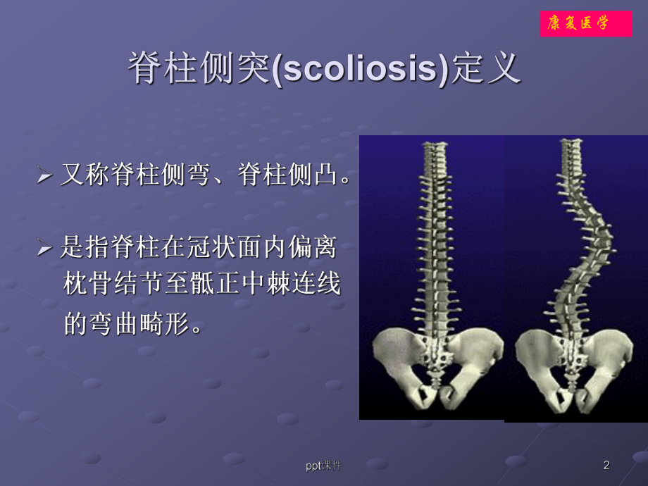 脊柱侧弯体操治疗（康复医学科）-ppt课件.ppt_第2页