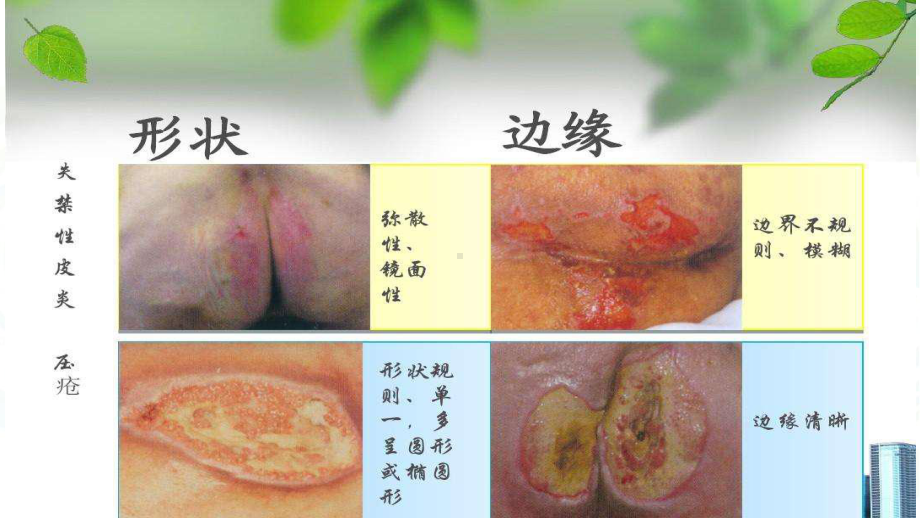 压力性损伤的预防与护理-ppt课件.ppt_第3页