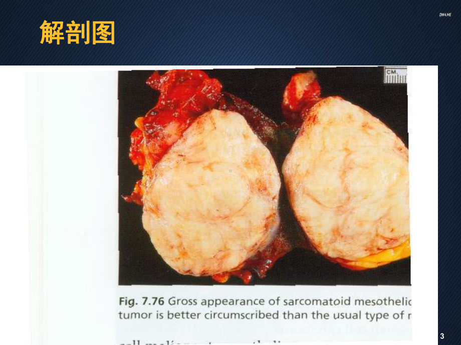 恶性胸膜间皮瘤-ppt课件.ppt_第3页