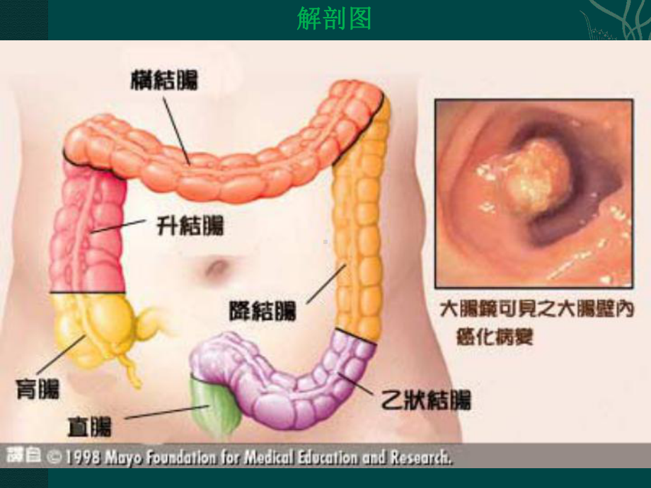 大肠癌的护理课件.pptx_第2页