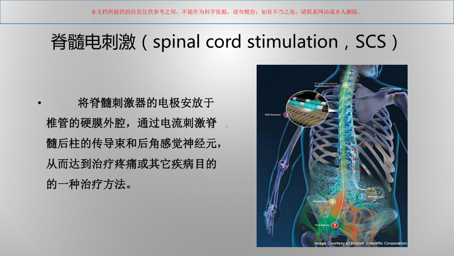 脊髓电刺激治疗的研究进展培训课件.ppt_第1页