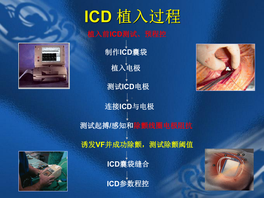 ICD植入术及并发症讲解课件.ppt_第2页