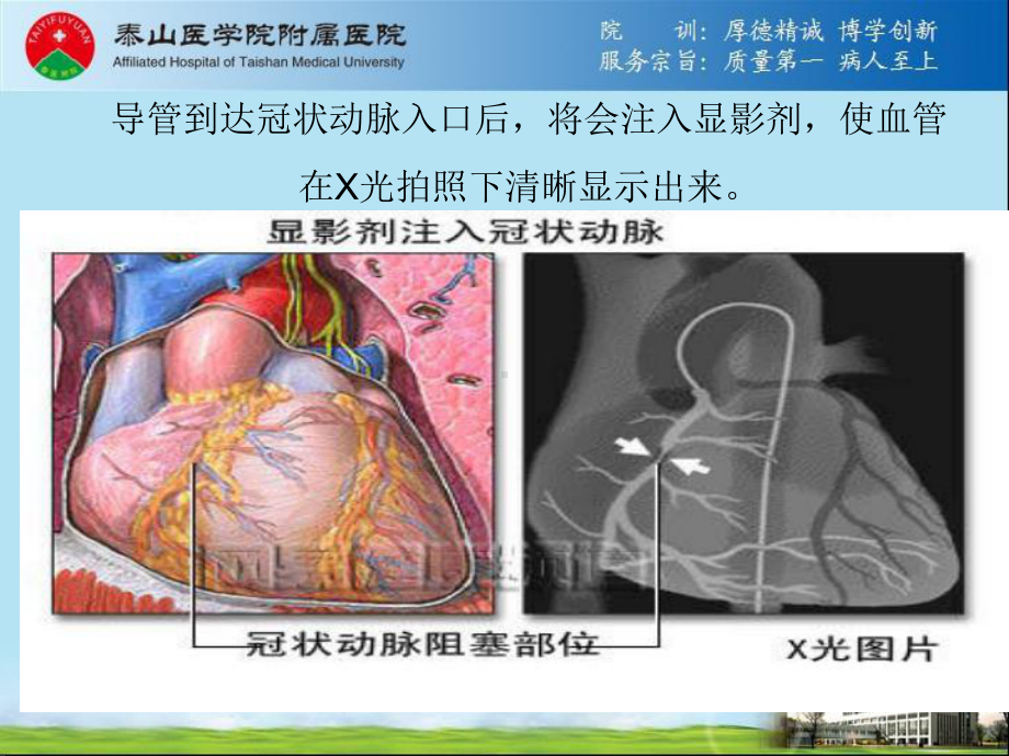 PCI术后并发症原因PPT课件1.ppt_第3页