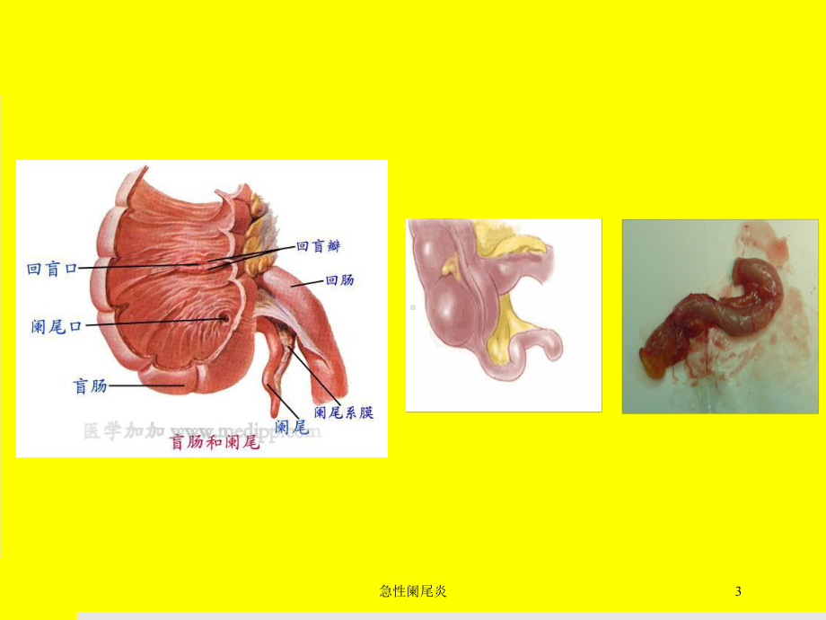 急性阑尾炎培训课件.ppt_第3页