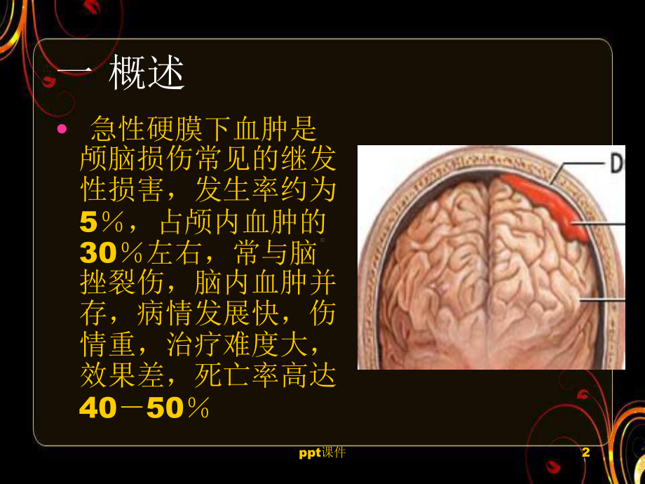 急性硬膜下血肿-ppt课件.ppt_第2页