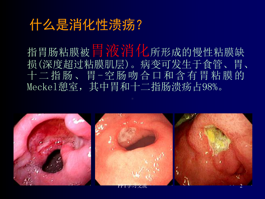 消化性溃疡最新版本PPT课件.ppt_第2页