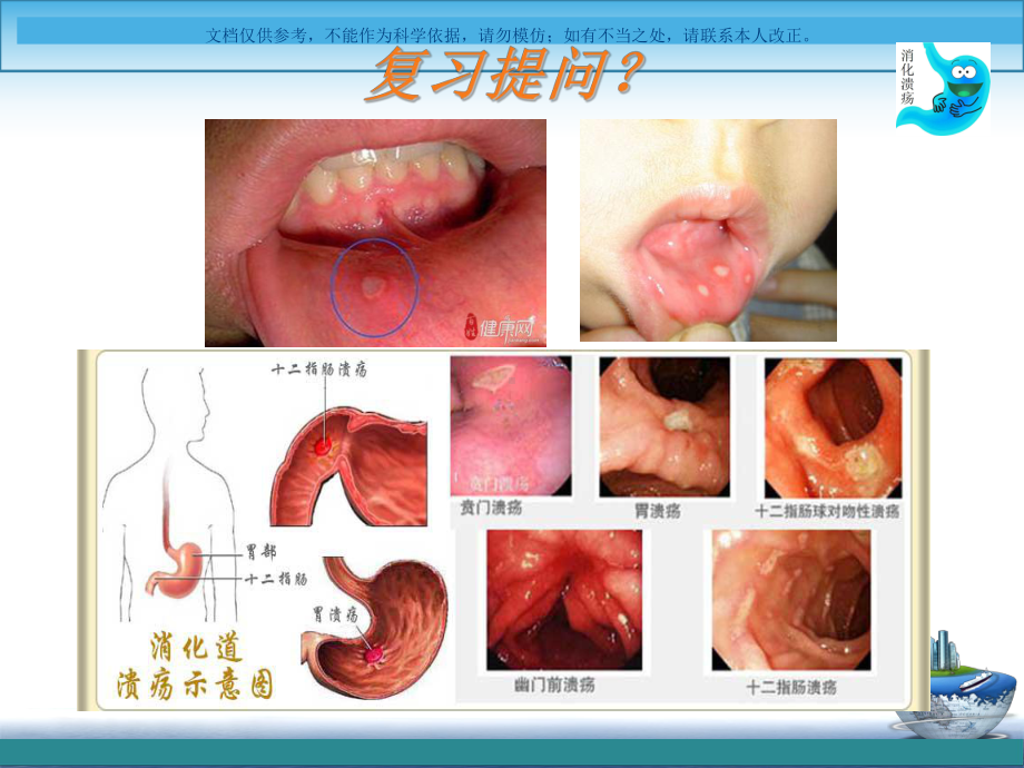 消化性溃疡病人的护理评估课件.ppt_第3页