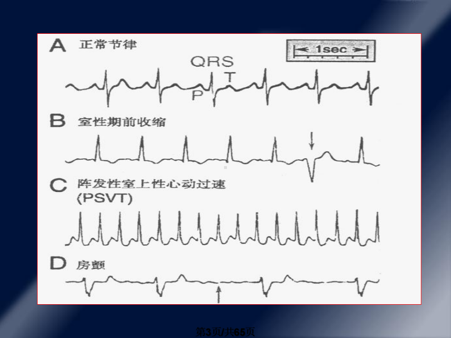22抗心律失常药课件.pptx_第3页