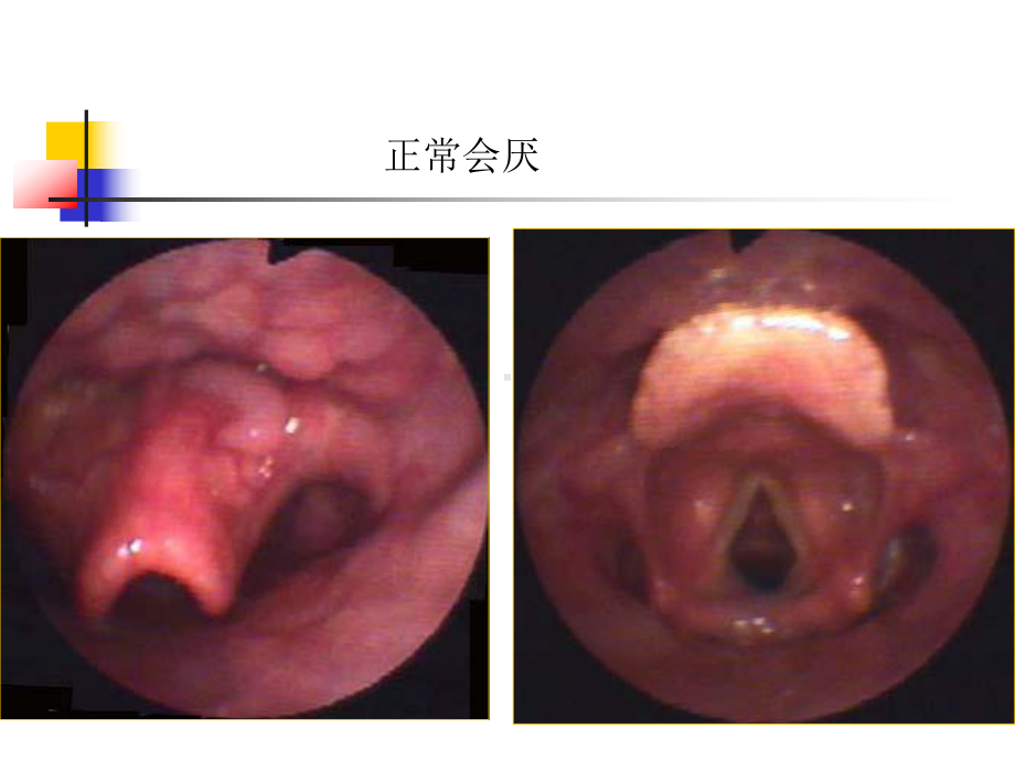 急性会厌炎专业医学知识宣讲讲义课件.ppt_第3页